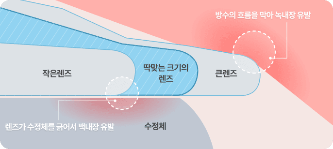안구공간에 맞춘 1:1 커스텀 렌즈 선택